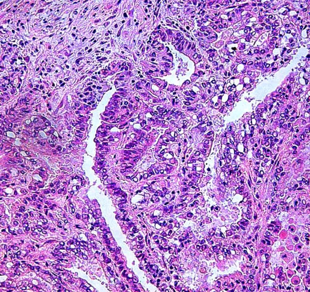cell carcinoma