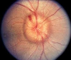 pressure Optic Neuropathy Papilledema Disc swelling from intracranial pressure Any