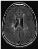 ONTT: MRI predicts the risk of MS 70 60 50 40 30 20 10