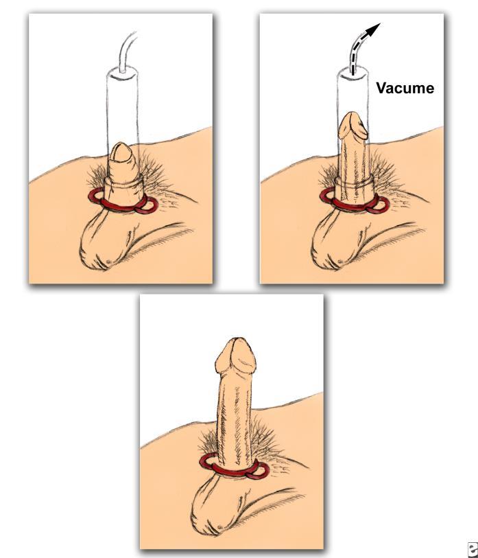 Vacuum erection device