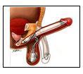 Penile prosthesis: Semi-rigid Malleable Avoid