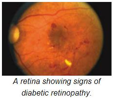 Diabetic Retinopathy (DR) - a disorder of the blood vessels in the retina of patients with DM 1 in 3 diabetic patients has DR; 1 in 10 has