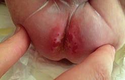 Pain complaints due to severe diaper dermatitis.