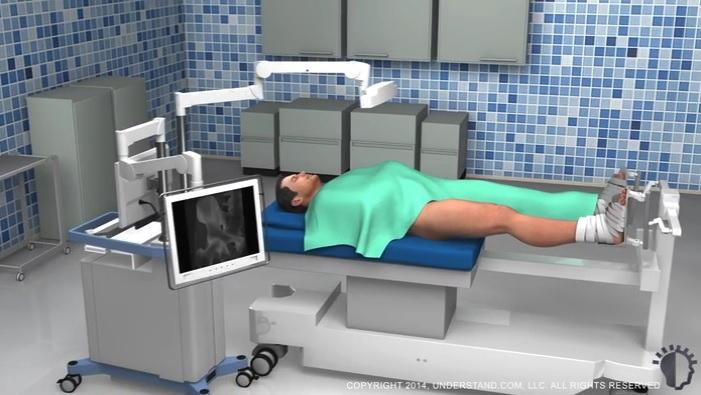 Preparation Prior to the procedure, X-rays will be taken to make measurements and develop an operative plan.
