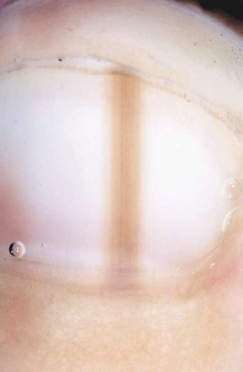 Figure 3. Nail apparatus melanocytic nevus in an 8-year-old boy.