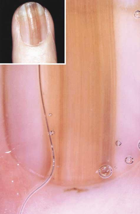 DRUG-INDUCED NAIL IGMENTATION Sixteen cases of drug-induced nail pigmentation were included in this study. In most cases the pigmentation was observed on several fingernails or toenails.