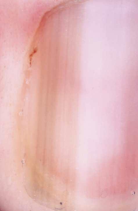 Nail apparatus lentigo in a 37-year-old woman with Laugier-Hunziker disease.