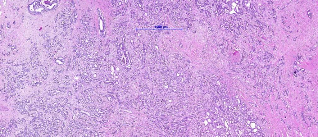 Invasive breast carcinoma NST Tumor cells form