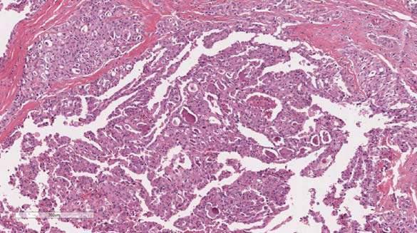Differential Diagnosis Granular cell tumour Can mimic invasive carcinoma Copious PAS/DPAS+ granular