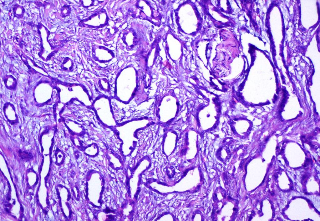 Pic 2:Microcystic adnexal carcinoma showing