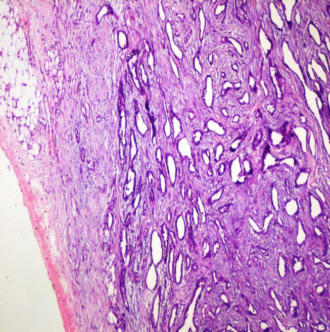 Pic 4-A & B:Microcystic adnexal carcinoma extending upto the deep surgical resected margin (H&E, 4X and 10X).