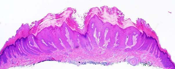 Basal Cell Carcinoma Seborrheic Keratosis Most common malignancy in humans Locally aggressive and destructive behavior Very low metastatic potential (<