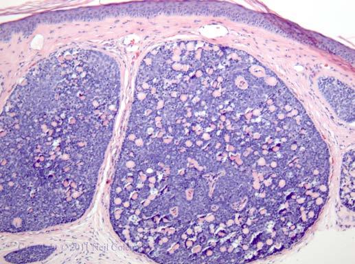 (Eccrine) Spiroadenoma blue cannonballs in the dermis Basophilic tumor nodules in dermis Tumor lobules may be partially encapsulated Biphasic appearance with 2 cell types: 1) Peripheral