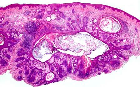Pilomatrixoma Well-circumscribed with mixture of 1) basaloid and 2) shadow/ghost cells (abundant pink cytoplasm and open space at their center where