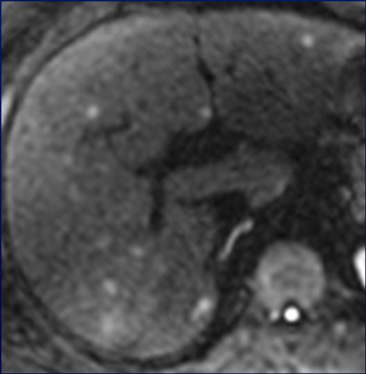 Hepatic Sarcoidosis 44 year-old man with