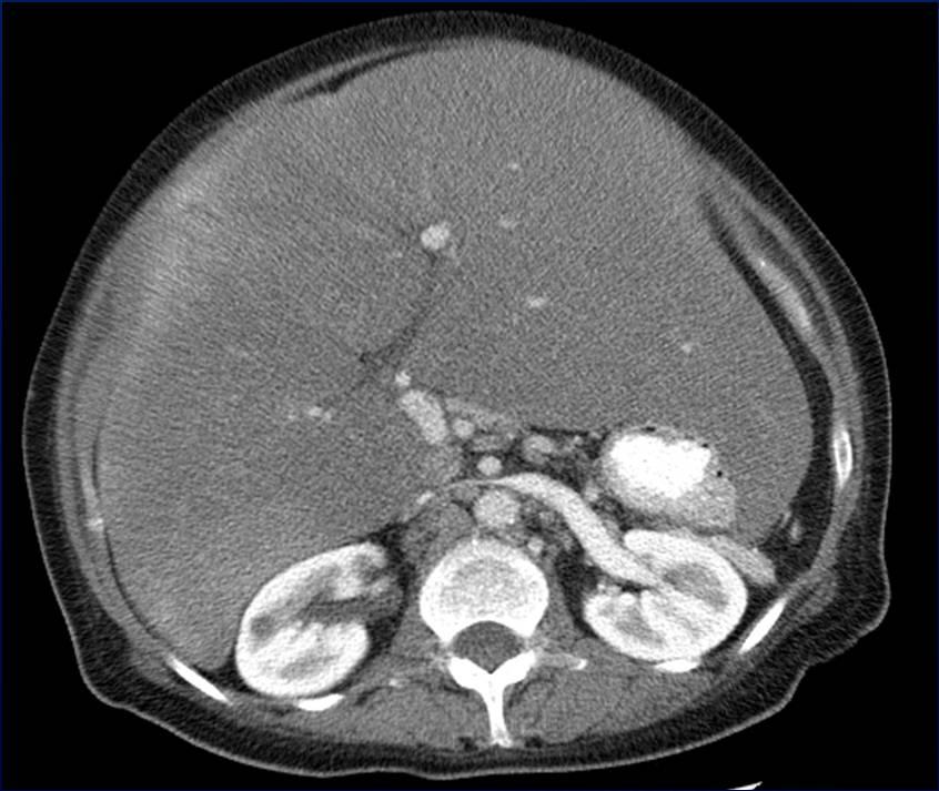 Amyloidosis 60 year old woman with abdominal pain: CT +C: Massive
