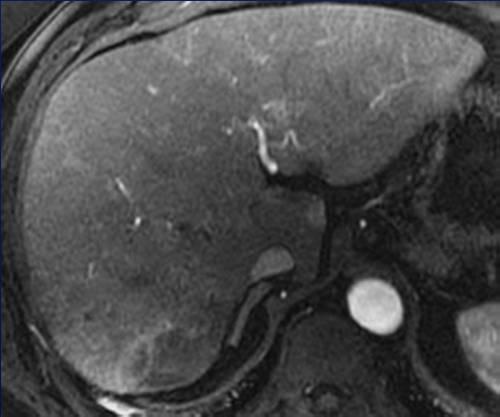 PVP Multiple non-circumscribed T2 hyperintense lesions in