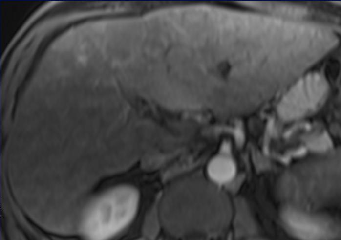 amyloidosis at biopsy CT Abdomen without