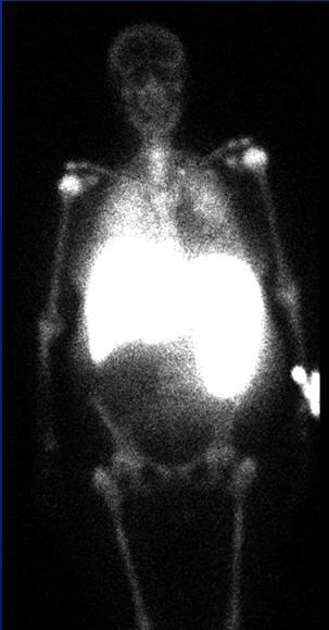 involvement CT images from an 83 year old woman with myelofibrosis show diffuse hepatosplenomegaly without focal lesions.