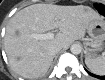 Infiltrative Metastases 33 year old woman with breast cancer