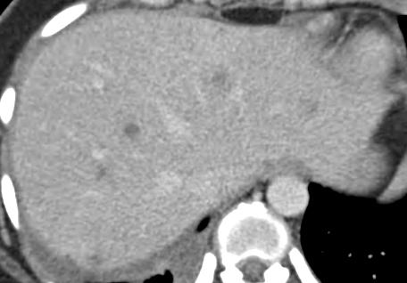 Staging CT 6 mo Follow-up exam after chemotherapy Typically