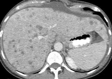 Infiltrative Metastases 3 months Chemotherapy 64 year old woman with infiltrating ductal
