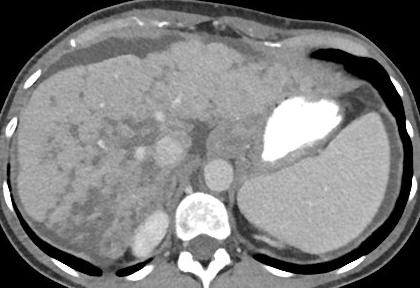 metastases Otherwise normal liver morphology Post-treatment CT: Pseudocirrhosis
