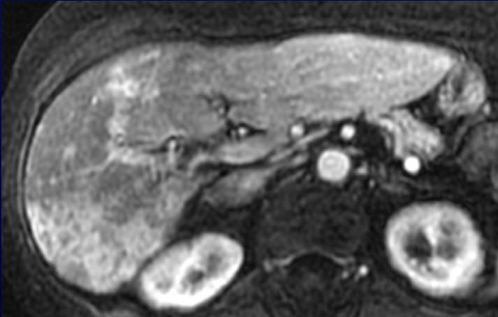 Infiltrative Metastases T2 74 year old