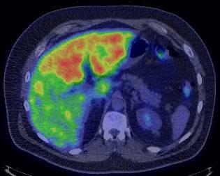 Infiltrative Metastases 58 year old man with right chest melanoma and