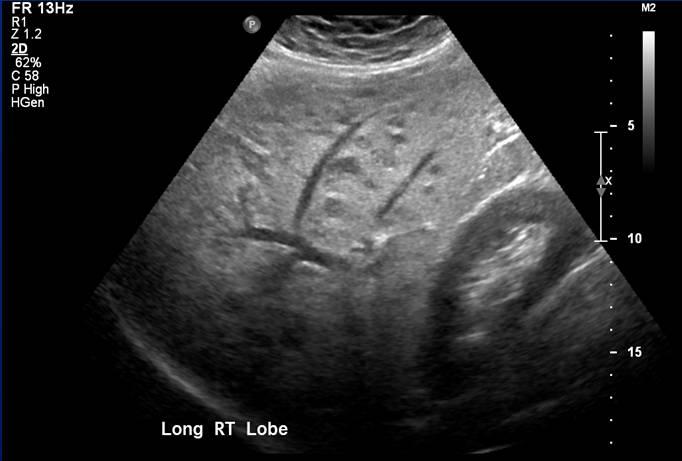 Abdominal sonogram: Sonogram obtained for abdominal pain and elevated