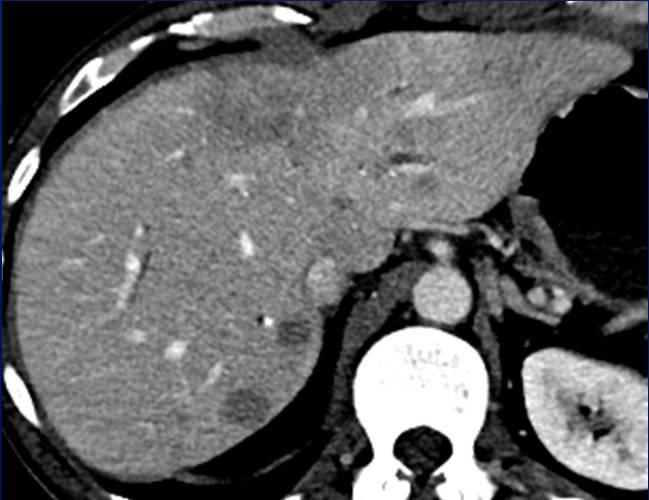 Infiltrative Metastases 59 year old man with metastatic small bowel neuroendocrine tumor: CT Abdomen: Geographic area of hypoenhancement within segments