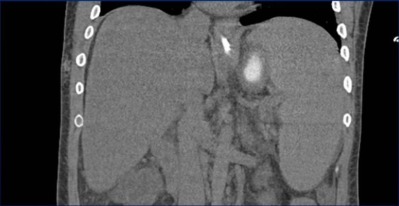 Sarcoidosis Imaging features Deposition may result in organomegaly Granulomas are microscopic and