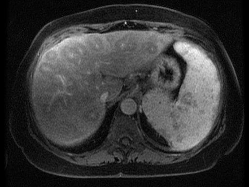 Hepatic Sarcoidosis 51 year-old woman with known