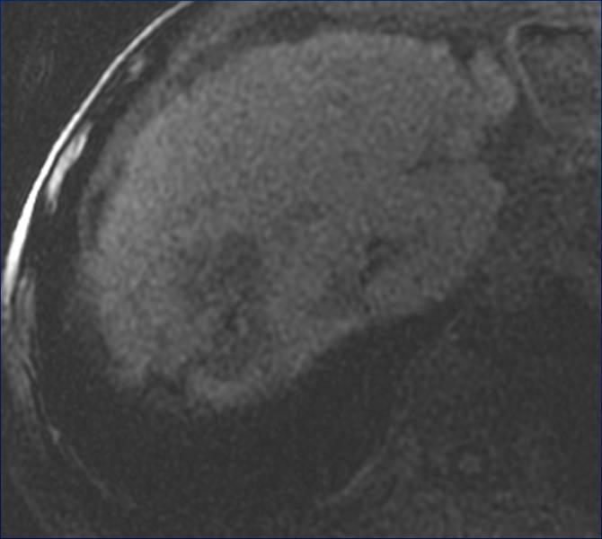 cirrhosis of the liver Liver Explant: Cirrhosis