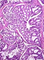 invasive carcinoma basal cell layer often intact and well-defined isolated (without invasive cancer) in bx