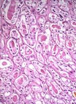 Acinar carcinoma Acinar carcinoma with ductal histology
