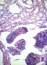 (pure or >80%) Acinar carcinoma with ductal histology