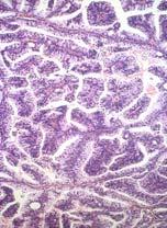 occasional most common histology when ductal pattern is