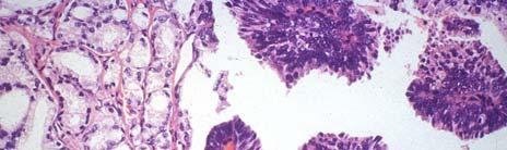 PROSTATIC DUCTAL CARCINOMA Architecture: Large glandular: Tubulo-papillary Growth pattern: Cribriform Solid Invasive