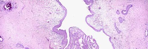 PROSTATIC DUCTAL CARCINOMA Clinical: