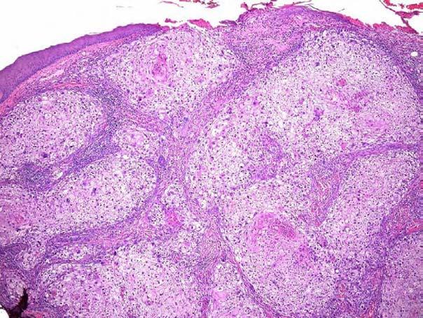 Sebaceous Carcinoma Clear cells reminiscent