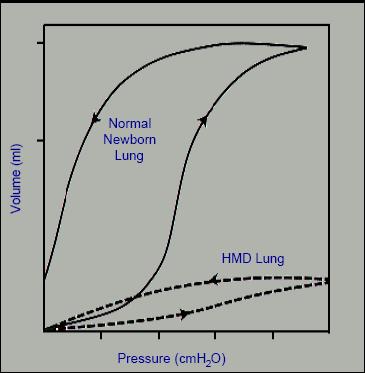 Pressure volume loop in HMD Relationship of lung condition with pressure volume loop The normal lung exhibits good change in volume for a given unit change in pressure.
