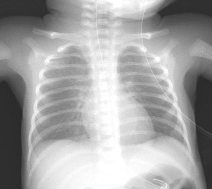 CXR showing adequate chest expansion (Posterior Intercostal