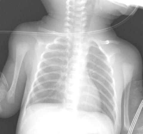 CXR showing over expansion (Posterior ICS of >9 spaces