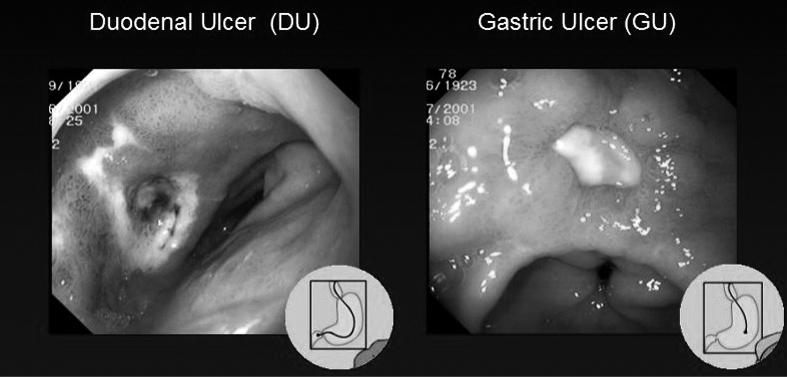 INTRODUCTION Gastric ulcer In contrast to duodenal ulcers, gastric ulcers (Figure 2B) are associated with low acid secretion in addition to H. pylori infection.