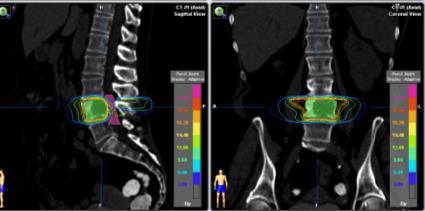 STIR Stereotactic Body Radiation Therapy Spine Radiosurgery SRS: