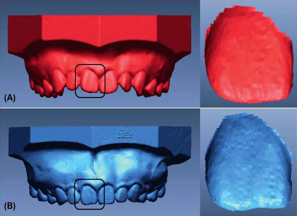 INCISOR WEAR IN CLASS III ORTHODONTIC PATIENTS 153 Figure 1. Construction of single-tooth three-dimensionl (3D) digitl model.