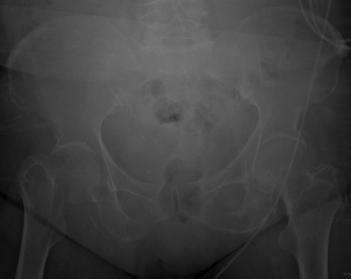 What is the next best step? 78 y/o female with PMHx HTN s/p fall from standing onto right hip with Garden IV femoral neck fracture.