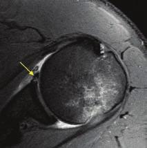 Slap tear with Hill-Sachs fracture and anterior dislocation Left and middle image shows slap tear (yellow arrow) with anterior dislocation and Hill-Sachs fracture (red arrow).