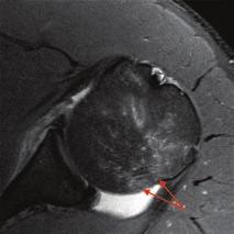 Slap type 2 tear in shoulder A slap, type 2 tear is seen on two consecutive axial proton density-weighted SPAIR fat suppressed slices (left and middle images).